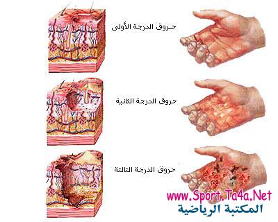 الحروق