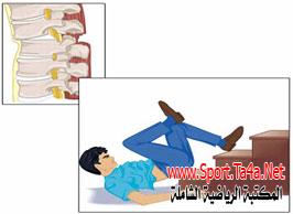 إصابات العمود الفقرى