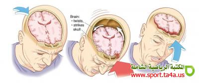 ارتجاج الدماغ