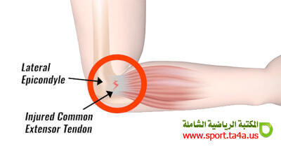 إصابة مرفق التنس